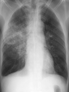 Green tea shown to fight pneumonia