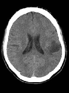 Caffeine intake reduces chances of brain tumors